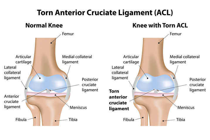 ANTERIOR CRUCIATE LIGAMENT (ACL)