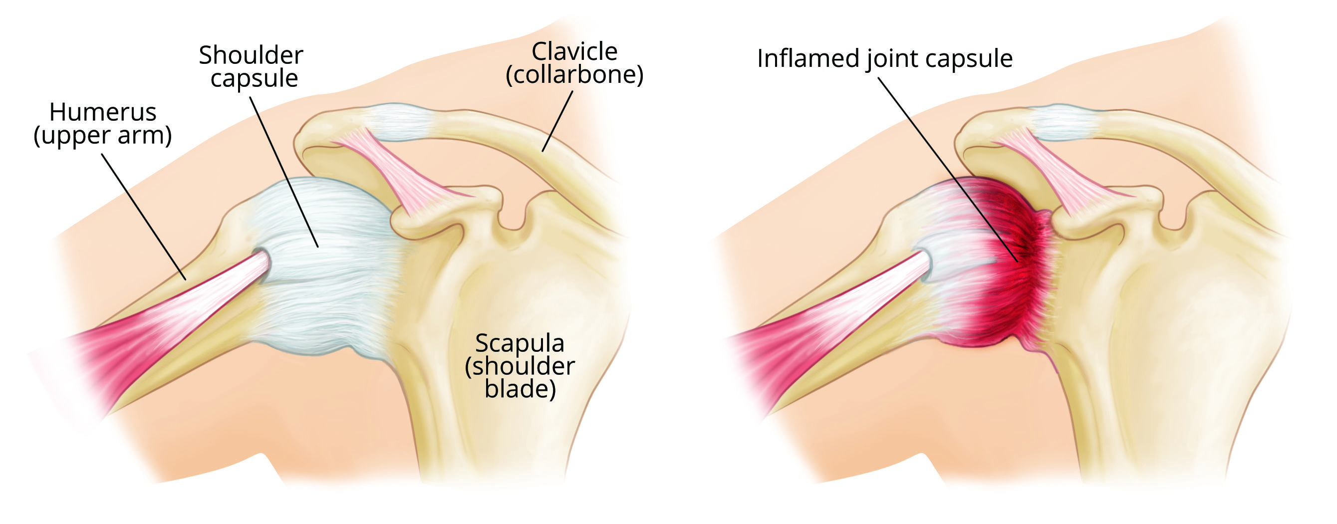 FROZEN SHOULDER