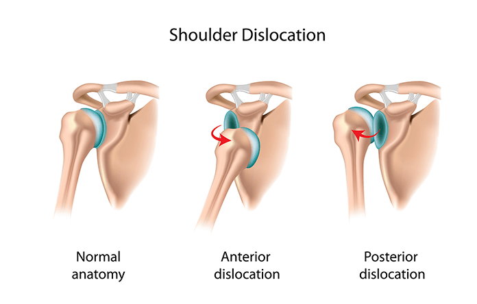 SHOULDER DISLOCATION