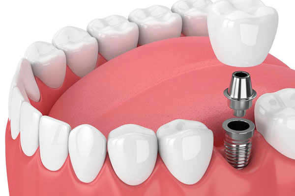 Dental